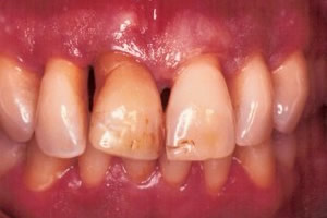 Advanced periodontal disease - before